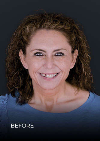 patient smiling before her single tooth restoration with  dental implants