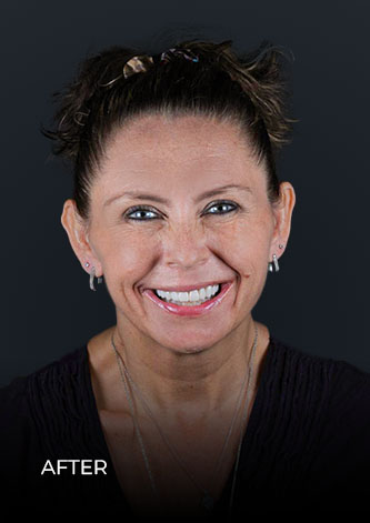 patient smiling after her single tooth restoration with  dental implants