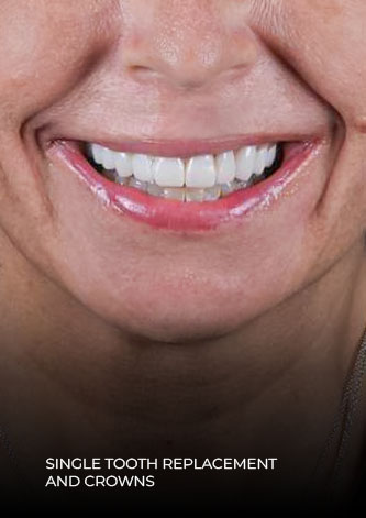 close up to permanent teeth done with crowns