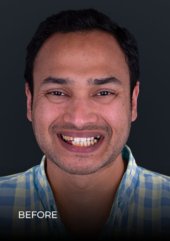 Patient before getting deep teeth cleaning in mexico