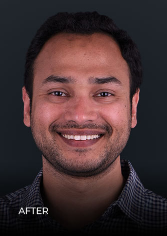 Patient after getting deep teeth cleaning in mexico