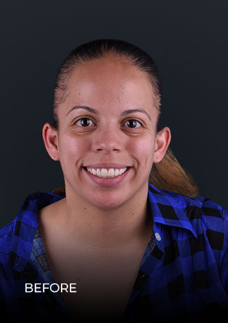 Patient before getting teeth whitening treatment