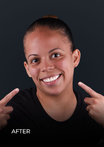 Patient after getting teeth whitening treatment