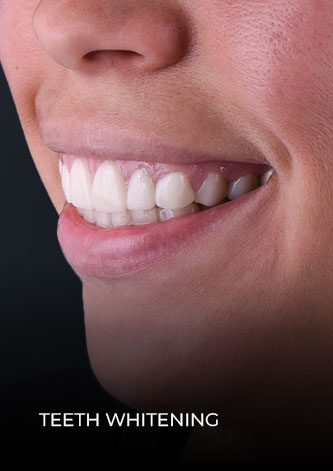 Patient after getting teeth whitening