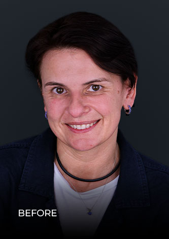 smiling before getting a laser teeth whitening treatment in mexico