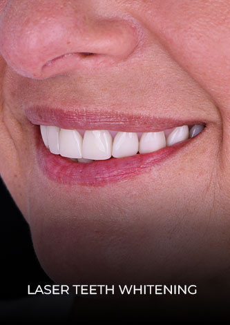 Close up smile after her laser teeth whitening treatment