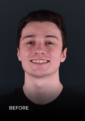 smiling before using whitening trays