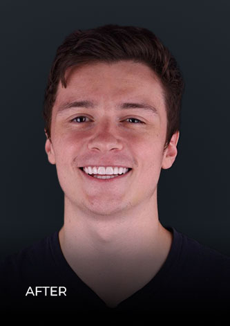 smiling after using whitening trays