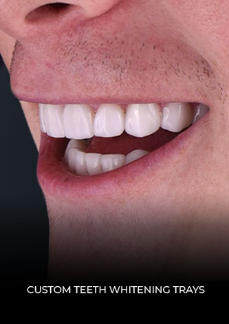 Close up smile after wearing custom teeth whitening trays