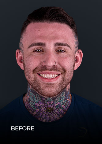 patient at dental work mexico smiling before getting teeth veneers