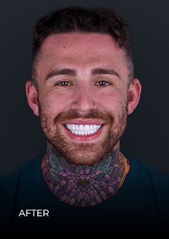 patient at dental work mexico smiling after getting teeth veneers