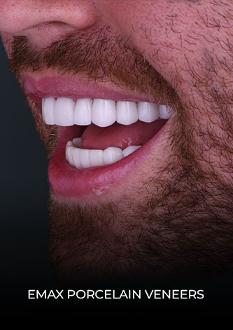 patient at dental work mexico final restoration with emax porcelain veneers