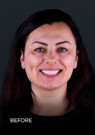 patient at dental work mexico smiling before having veneers in Cancun Mexico