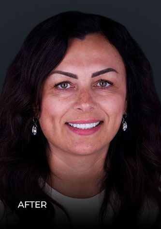 patient at dental work mexico smiling before having veneers in Cancun Mexico