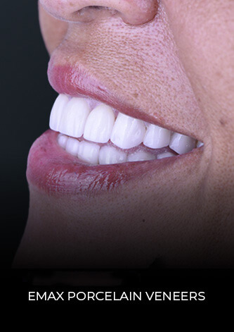 patient at dental work mexico final restoration with porcelain veneers