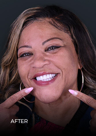 patient at dental work mexico smiling after getting veneers in Mexico