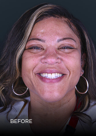 patient at dental work mexico smiling before getting veneers in Mexico