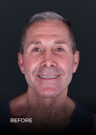 smiling before his zoom teeth whitening in Mexico