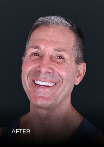 smiling after his zoom teeth whitening in Mexico