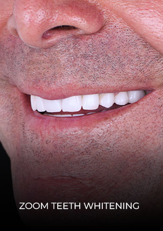 Close up smile after his zoom teeth whitening